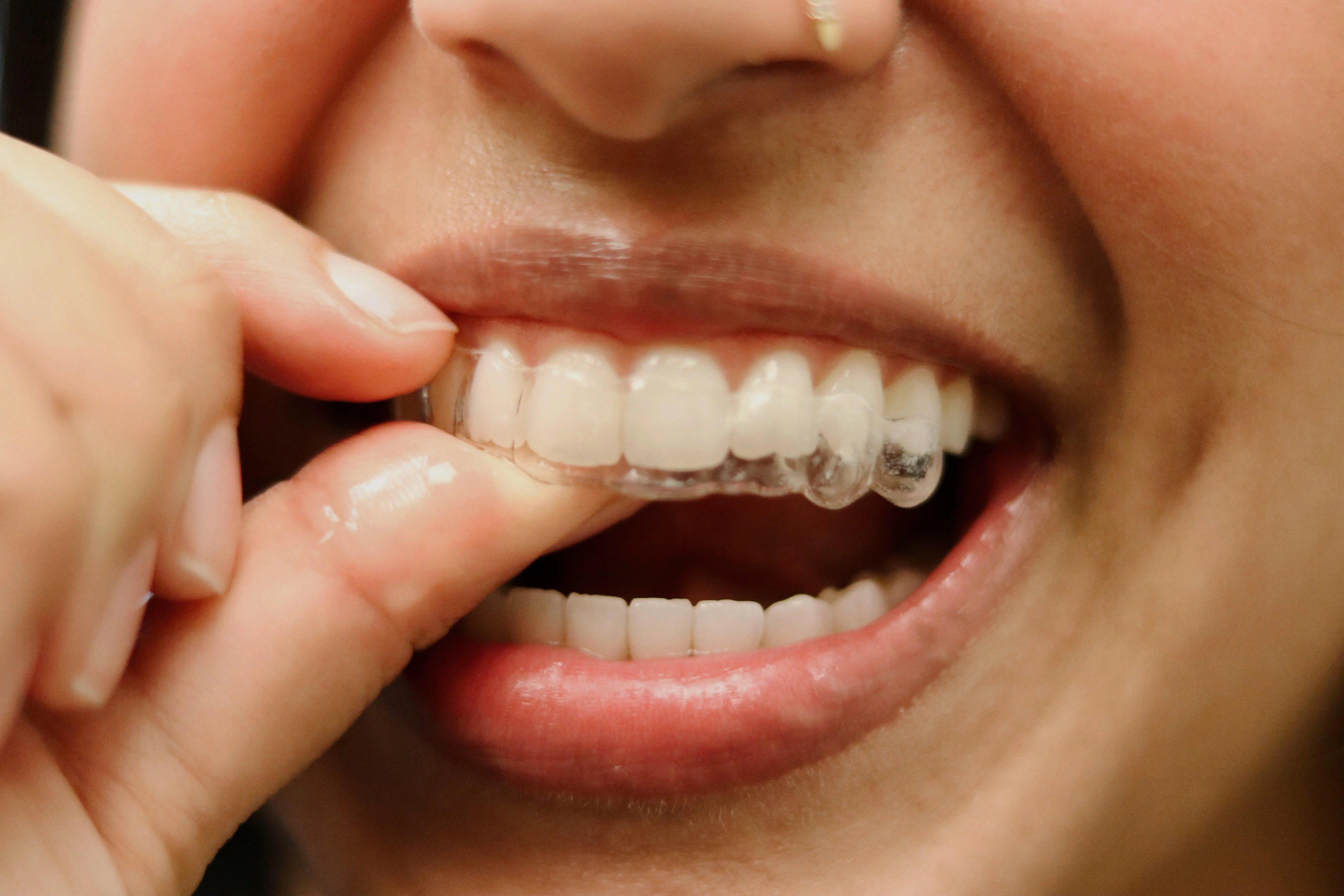 AlignerMaryville AlignerMaryville